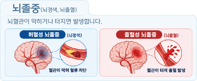 허혈성 뇌졸중과 출혈성 뇌졸중 설명